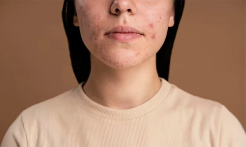 A Realistic Way to Approach Acne Healing