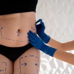 Is-It-Fine-to-Go-for-a-Liposuction