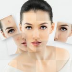 probiotics help in getting rid of acne