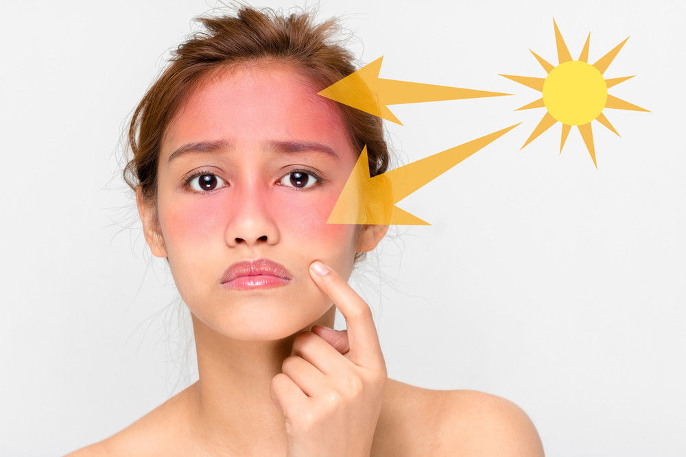 Sun rays Caused Sunburns, what to do?