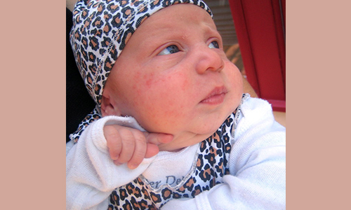 Baby Acne