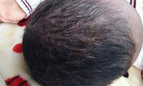 Cradle Cap