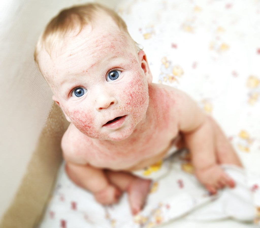 Atopic dermatitis in baby