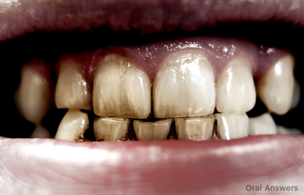 craze_lines_stained_teeth