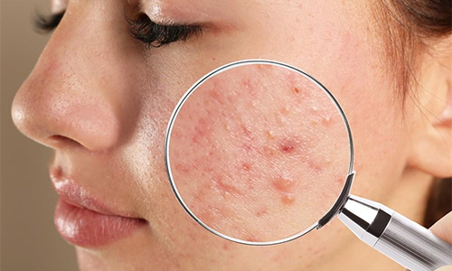 Reduction of Acne Scars