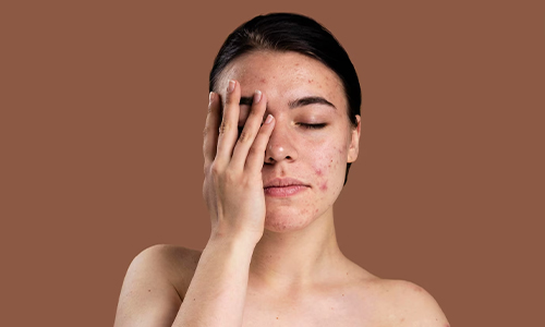 Serum Overuse Causes Pimples