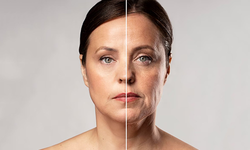Facial wrinkles during menopause