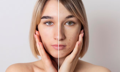 lear skin Vs dark spots skin