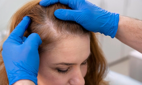 Close up image of Woman getting a hair loss treatment at a clinic