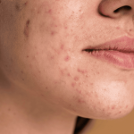 Close-up of a young woman’s lower face showing acne, blemishes, and mild scarring on the cheeks and chin.