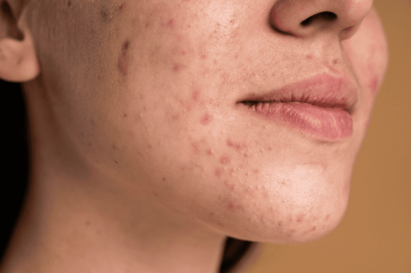 Close-up of a young woman’s lower face showing acne, blemishes, and mild scarring on the cheeks and chin.